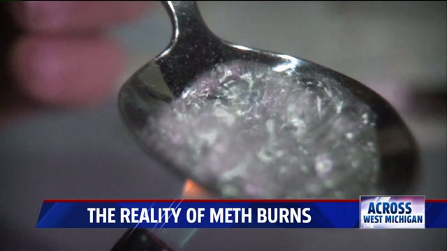 Scars of meth: beyond the addiction