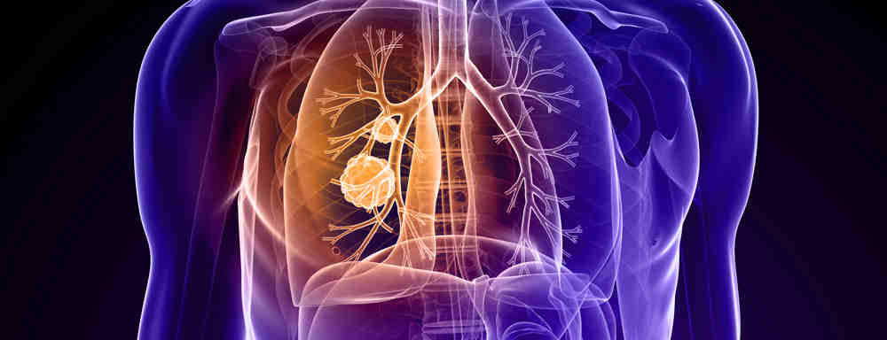 Lung Cancer screenings work to reduce cases of lung cancer